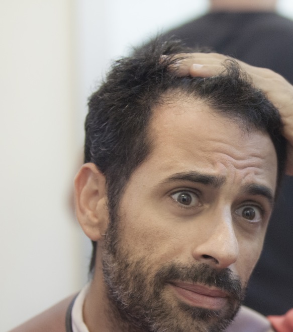 alopecia