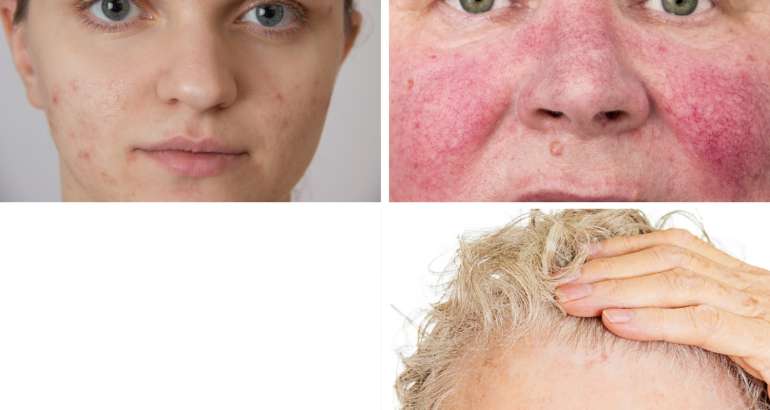 4 de las ultimas novedades en tratamientos dermatológicos