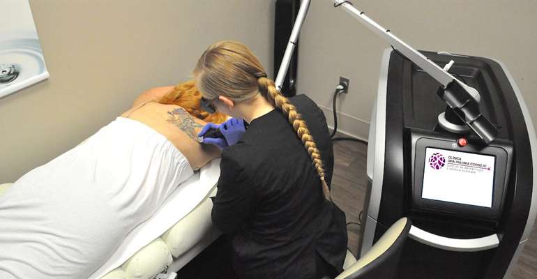 Nuevo láser para la eliminación de tatuajes