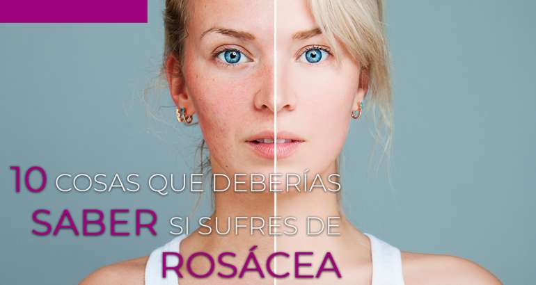 10 cosas que deberías saber si sufres de rosácea