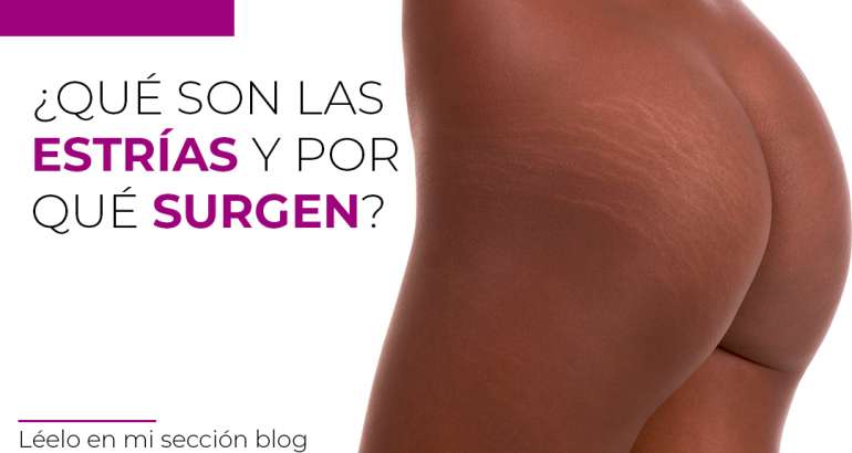 ¿Qué son las estrías y por qué surgen?