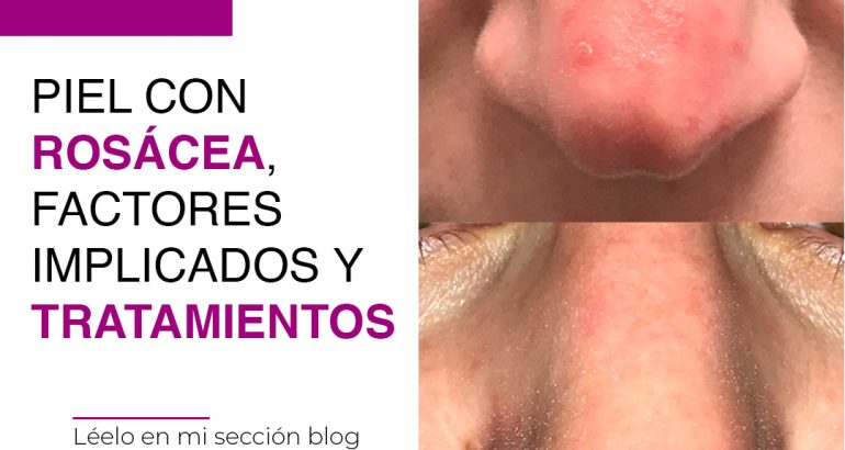 Piel con rosácea