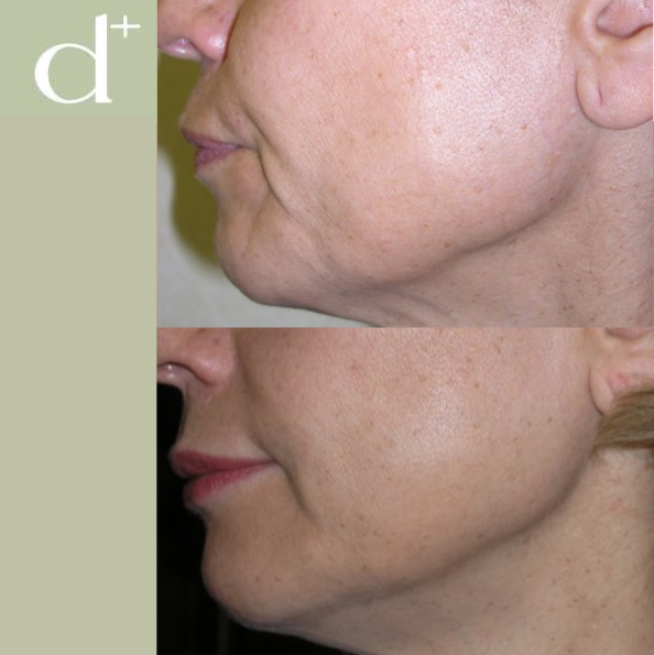 HIFU en Madrid: reafirmación facial sin cirugía en Más Que Derma