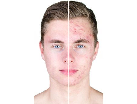 Eliminación del Acné – Peeling – Luz Azul – Laser