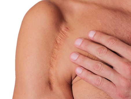 Eliminación de Cicatrices – Peeling – Laser – Carboxiterapia