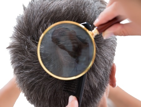 Tratamiento del la Alopecia – Mesoterapia – Luz Roja
