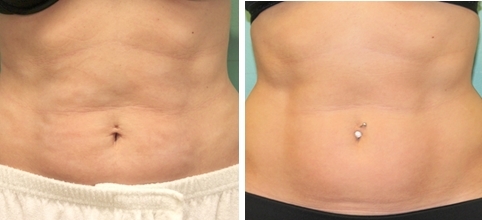 Radiofrecuencia-exilis-antes-despues-21