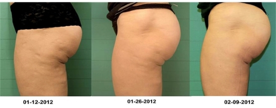 Radiofrecuencia-exilis-antes-despues-4