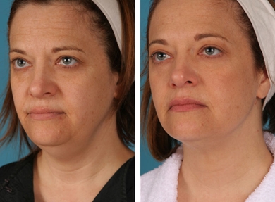 Radiofrecuencia-exilis-antes-despues-5