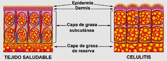 piel-celulitis