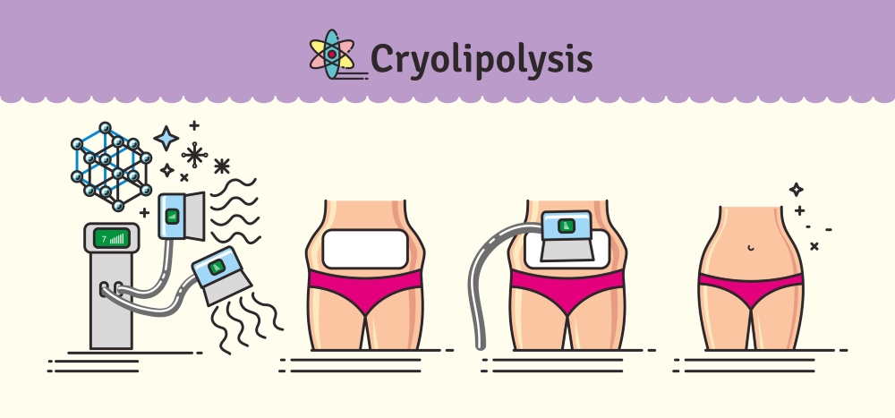 criolipolisis-2