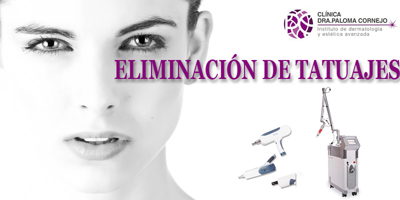 eliminar tatuajes