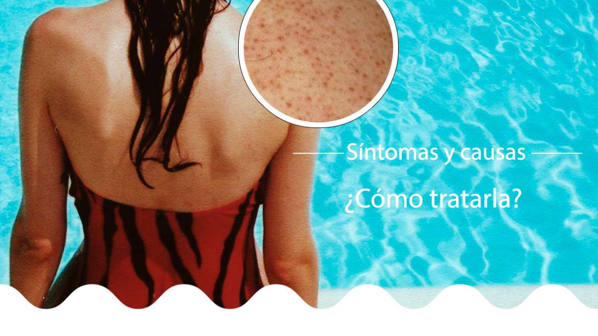 ¿Cómo tratar la Queratosis pilaris?