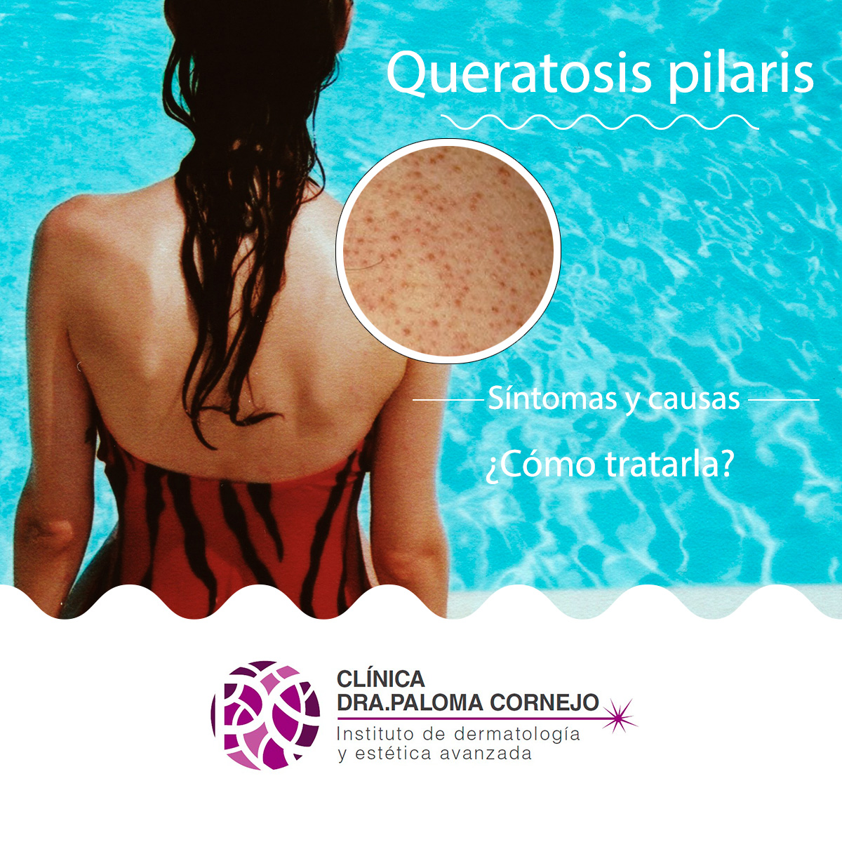 ¿Cómo tratar la Queratosis pilaris?