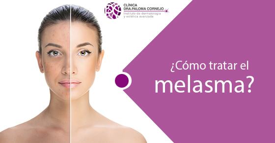 ¿Cómo tratar el melasma?