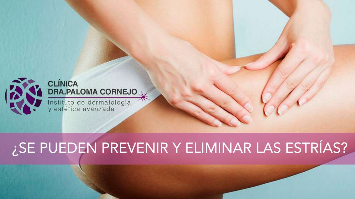 ¿Se pueden prevenir y eliminar las estrías?