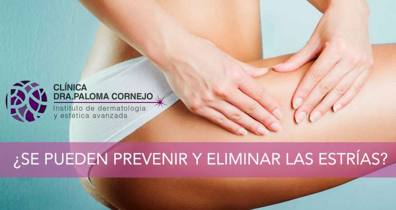 ¿Se pueden prevenir y eliminar las estrías?
