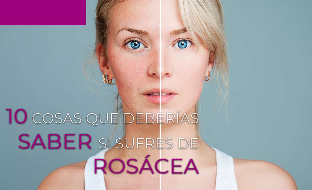 10 cosas que deberías saber si sufres de rosácea