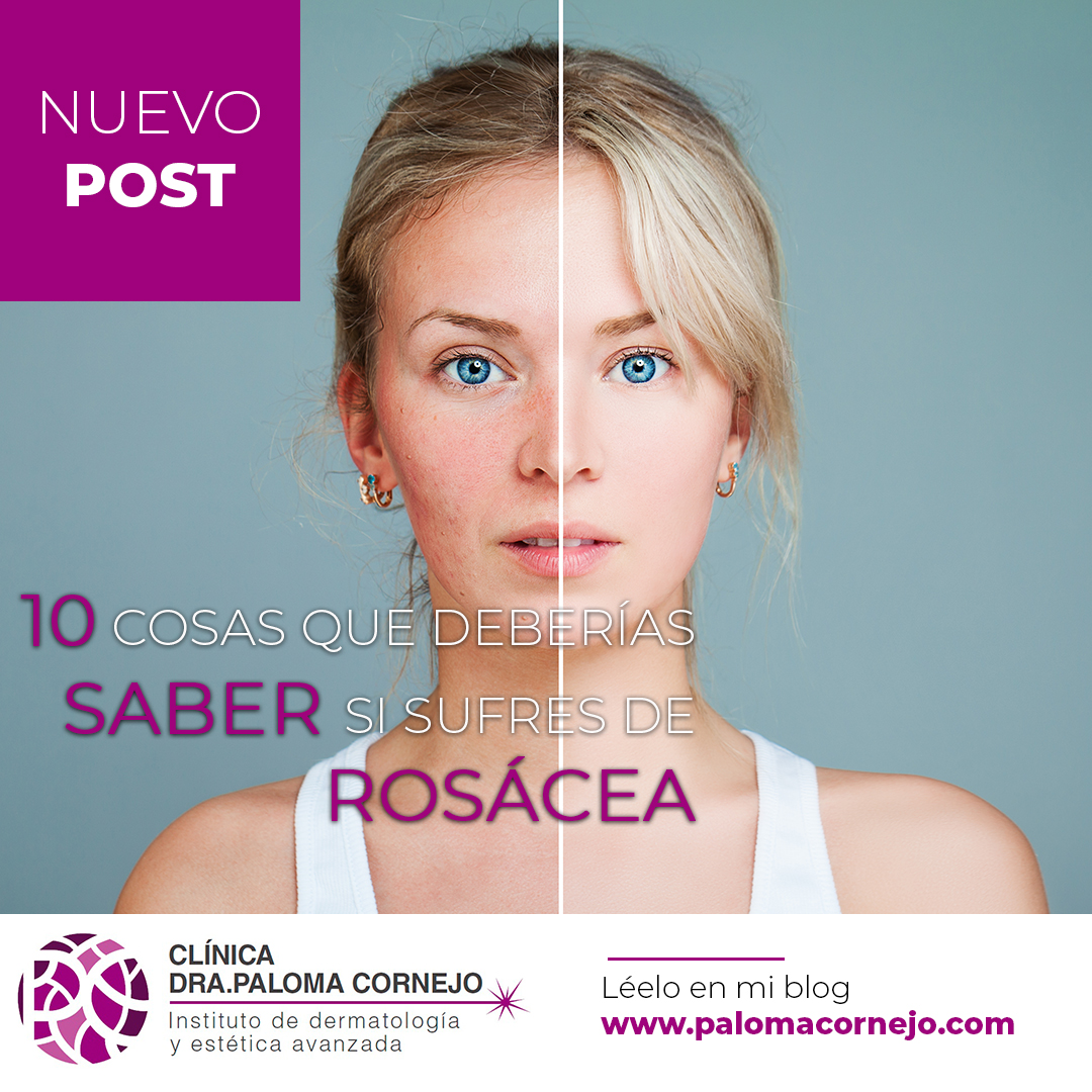 10 cosas que deberías saber si sufres de rosácea