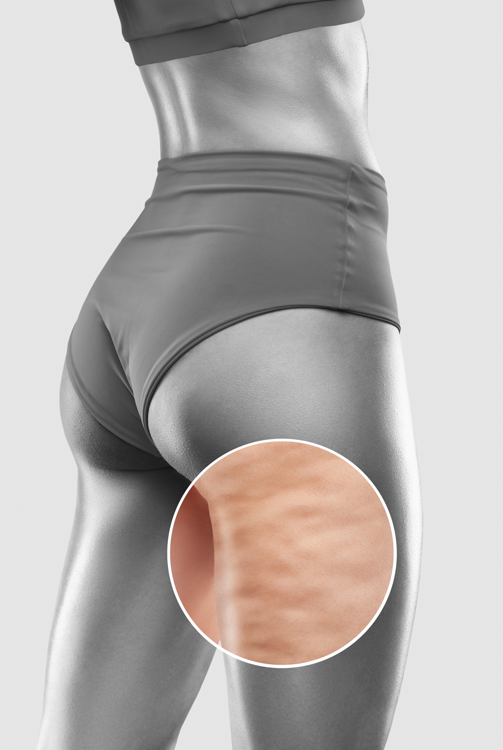Celulitis