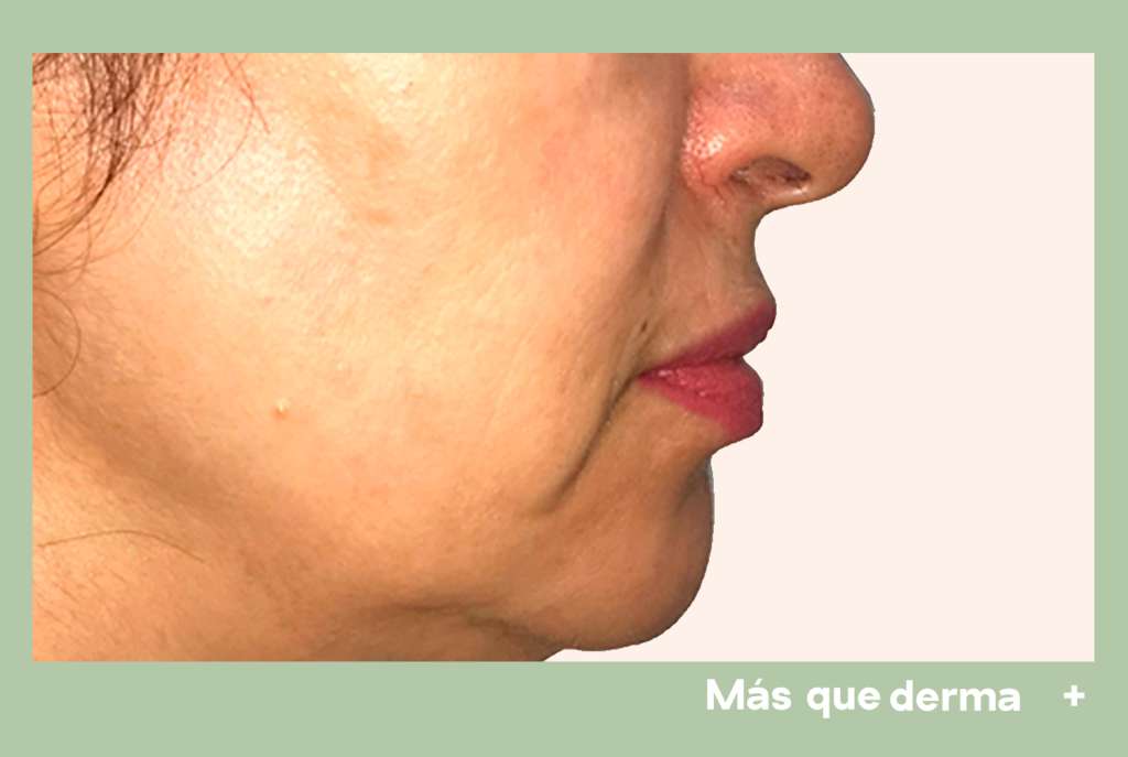 post-lentigos-seborreica-3