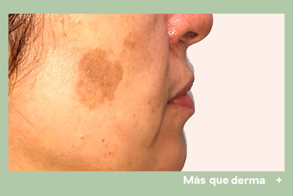 pre-lentigos-seborreica-3