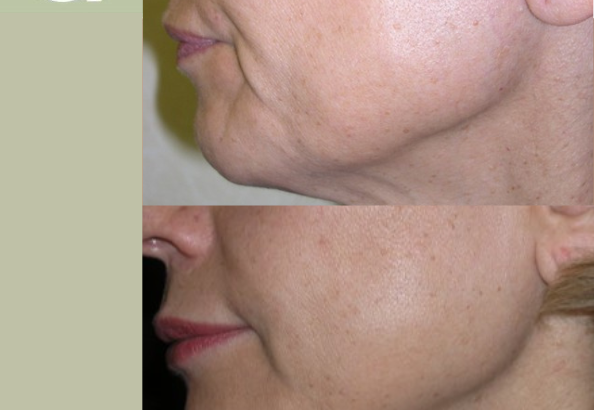 HIFU en Madrid: reafirmación facial sin cirugía en Más Que Derma